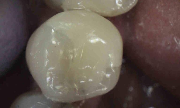 Amalgam-Filling-Restoration-After-Image