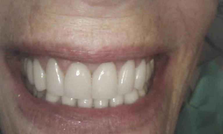 EMax-Veneers-and-Crowns-After-Image