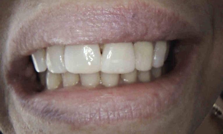 In-Office-Composite-Veneers-After-Image