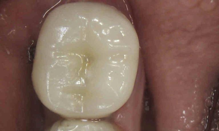 Same-Day-CEREC-Crowns-After-Image
