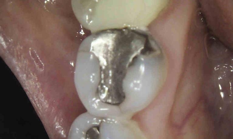 Amalgam-Filling-Restoration-Before-Image
