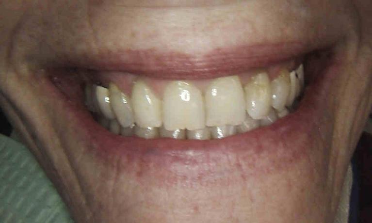 EMax-Veneers-and-Crowns-Before-Image