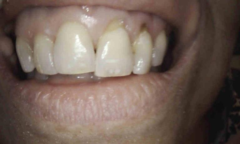 In-Office-Composite-Veneers-Before-Image