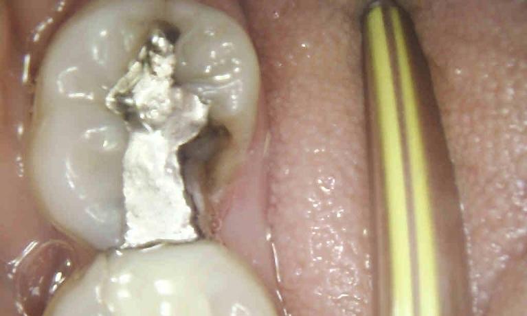 Same-Day-CEREC-Crowns-Before-Image